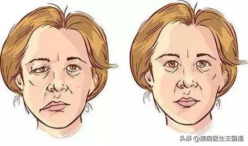 面肌痉挛打肉毒素能根治吗,面肌痉挛打肉毒素可以治愈吗