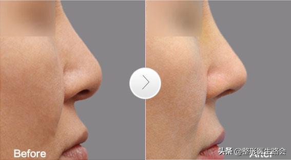 好看的鼻子要有哪些特点,很自然又好看的鼻子