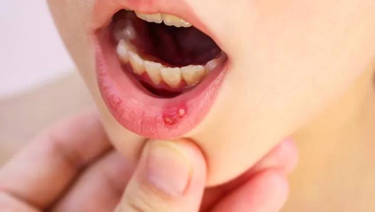 反复口腔溃疡用啥中成药较好,口腔溃疡老是反反复复喝什么中药