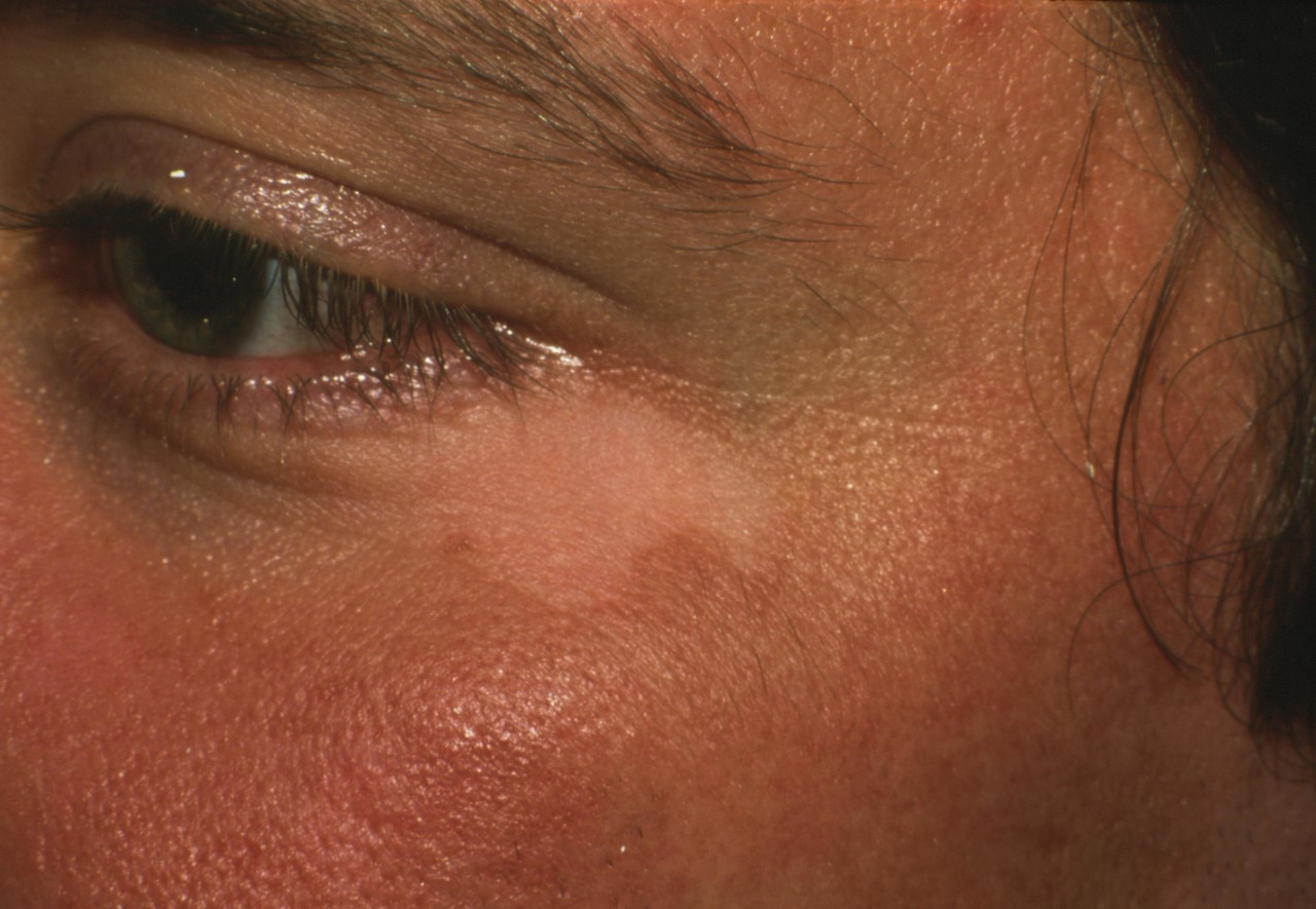 熬夜对白癜风有什么影响？