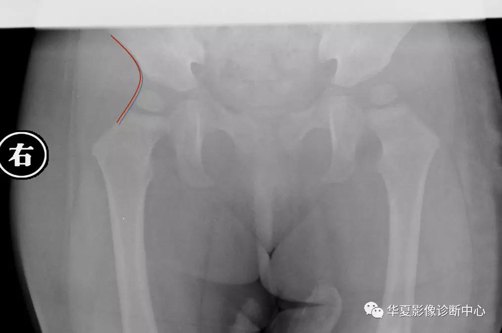 先天性髋关节脱位,先天性髋关节脱位属不属于残疾人