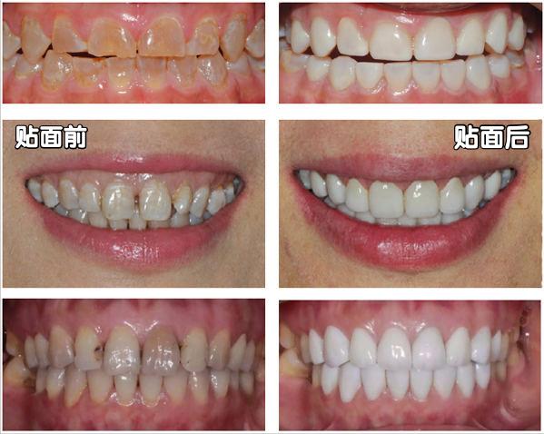 牙齿美白有这几种方法你了解多少,牙齿美白靠谱吗十年牙医告诉你