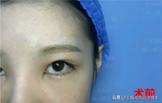 刚做完双眼皮闭眼总翻白眼正常吗,割了双眼皮为啥眼睛老流泪