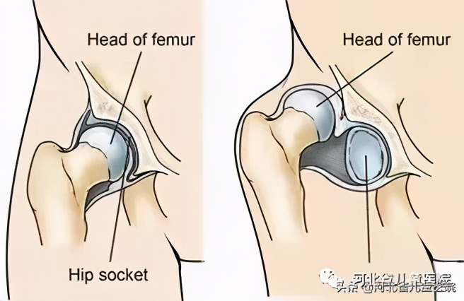 腿纹不对称家长千万别忽视,腿纹深浅不一样算不对称吗