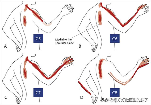 颈椎骨刺压迫神经怎么治疗,颈椎间盘突出压迫神经的症状