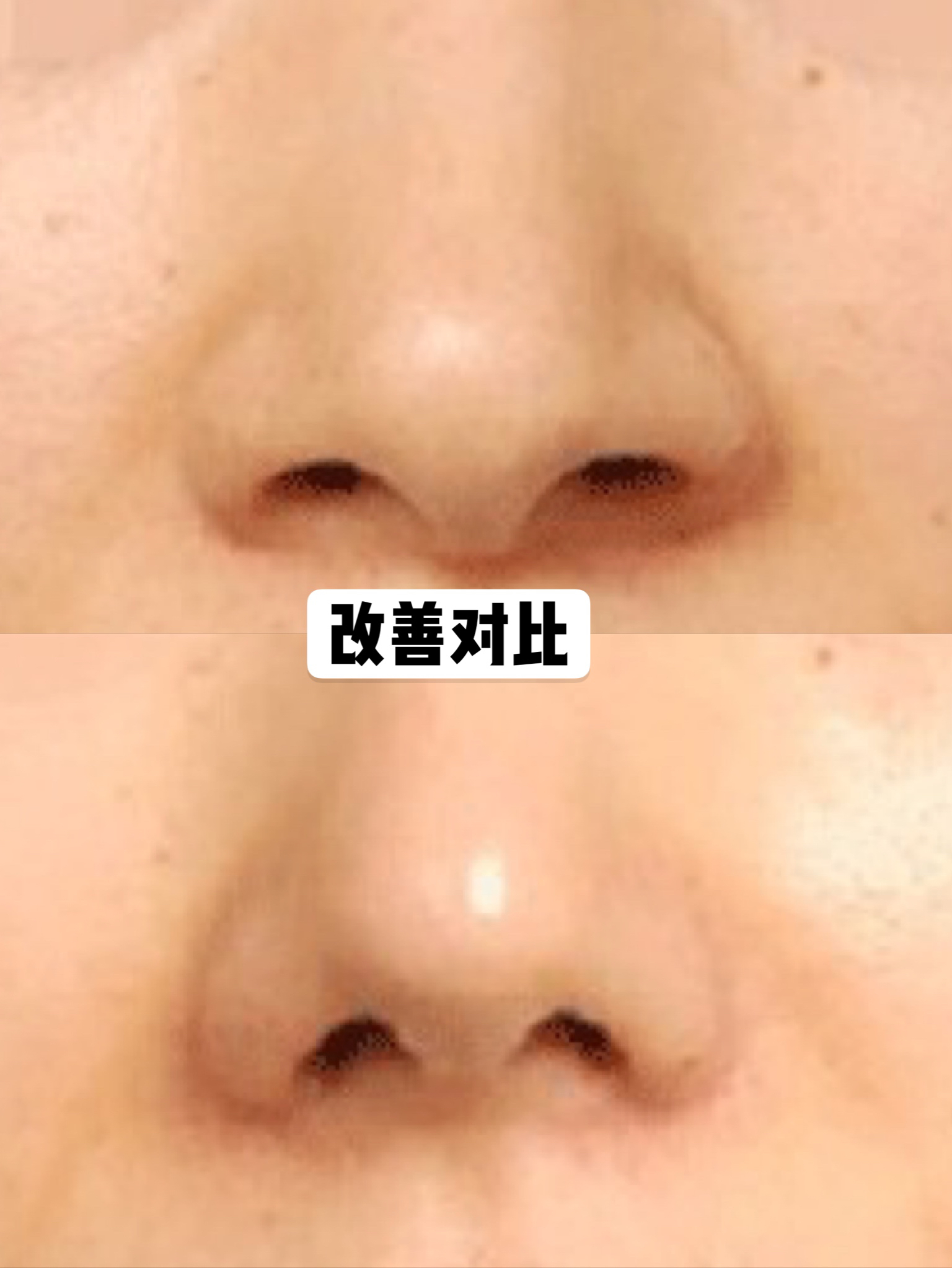 鼻翼缩小可以单独做吗,鼻翼缩小可以内切吗