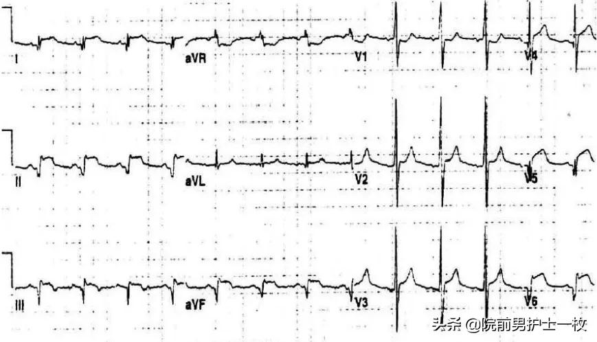 急性心梗的紧急处理视频,一旦发现急性心梗如何救