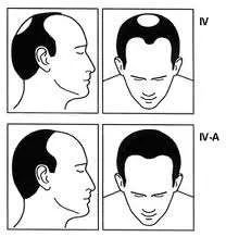 人每时每刻都在脱发吗,大多数人脱发的原因