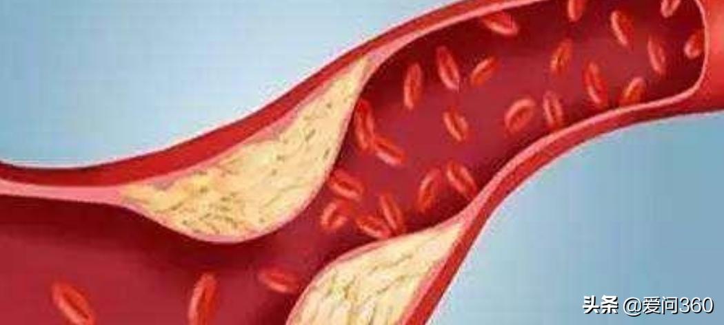 血管没有弹性什么原因该怎么治,血管失去弹性与血虚有关吗