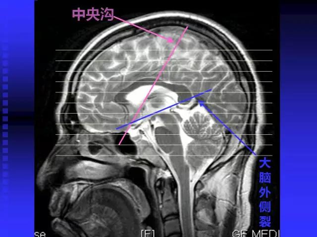 头颅mri读片视频教程,颅脑mri读片入门教程视频讲解全集