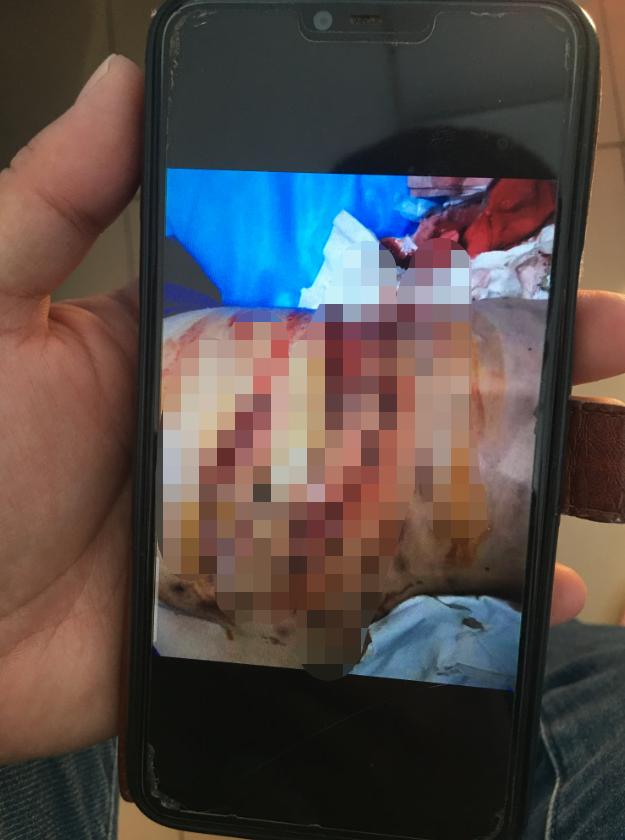 针灸感染,河南诊所针灸感染