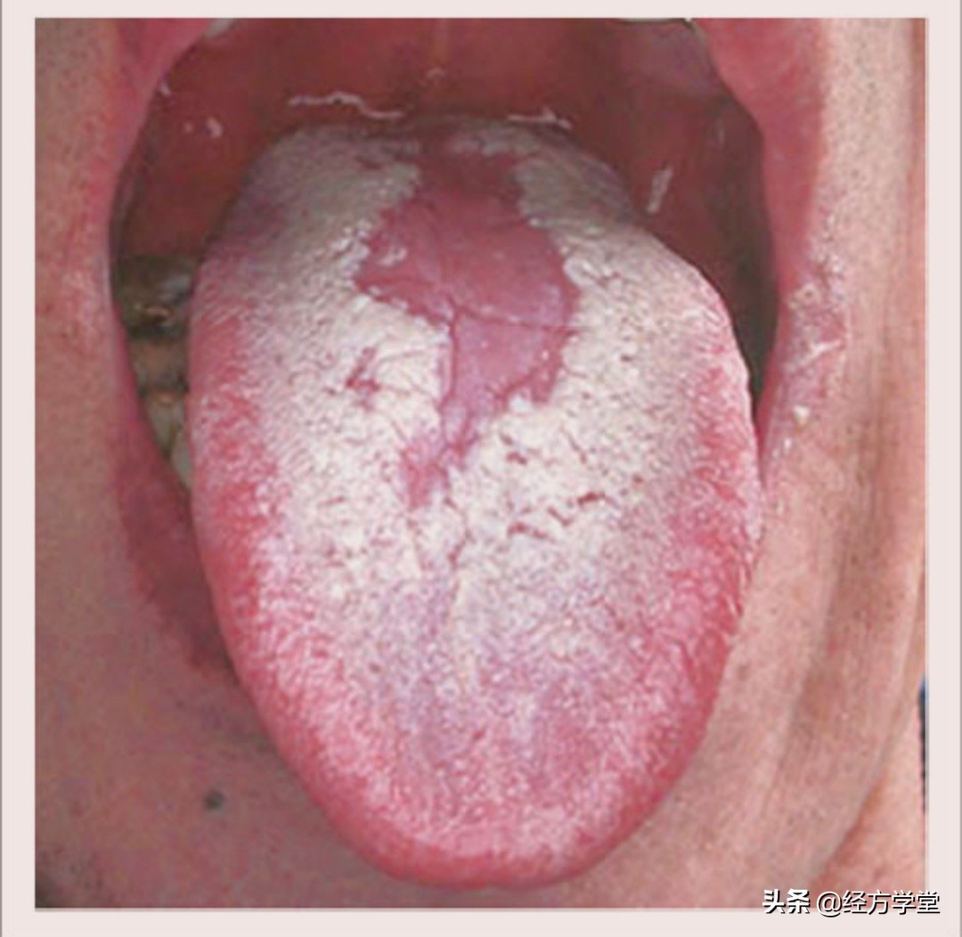 观舌养生舌诊入门一学就会,舌诊图片与经方治疗