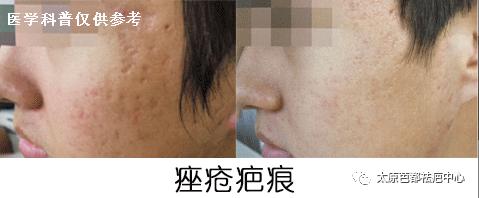 疮疤怎么祛疤,疮疤去除