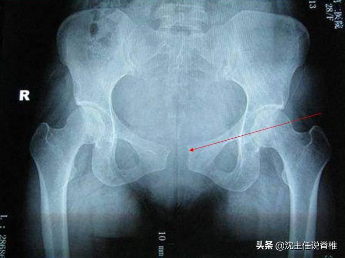 困扰产后妈妈的耻骨痛,该怎么办?