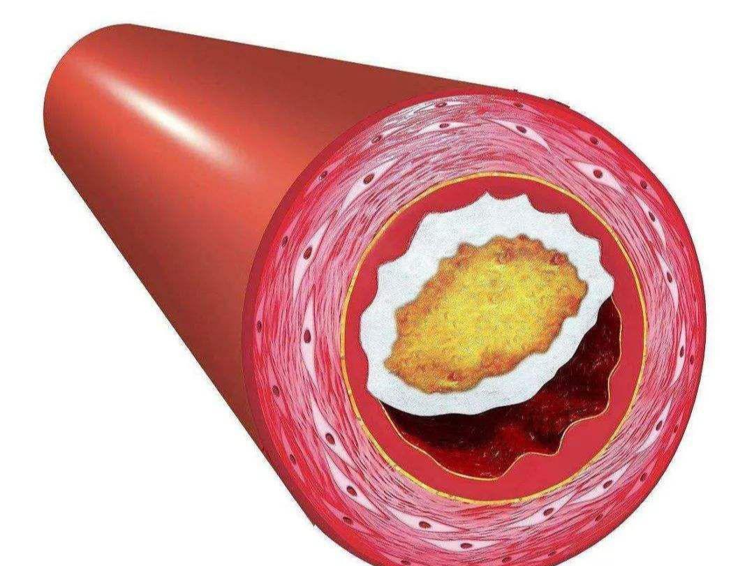 脂蛋白肾病发病机制,脂蛋白肾病是难治性肾病吗