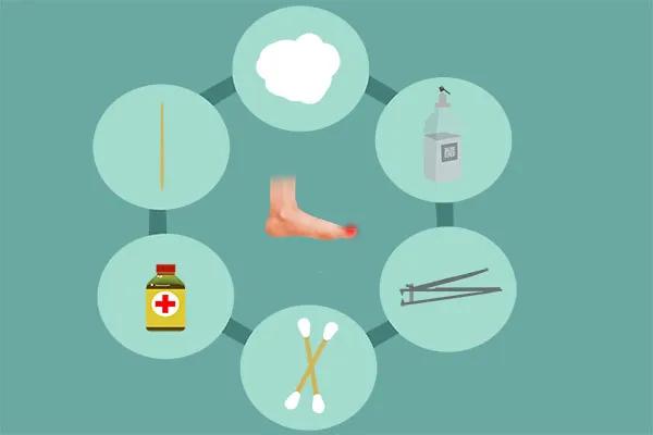 彻底治愈脚趾甲往肉里长的方法,脚趾甲侧面嵌甲自己怎么处理