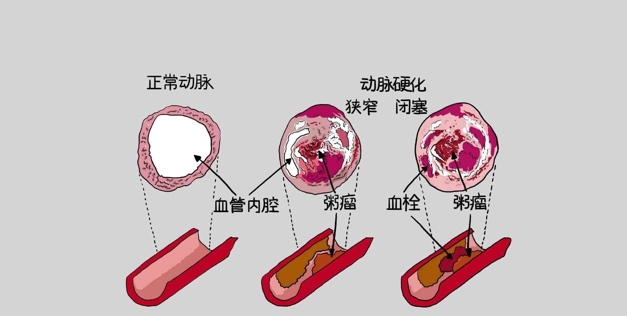 什么是冠心病介入治疗,冠心病介入治疗的利与弊