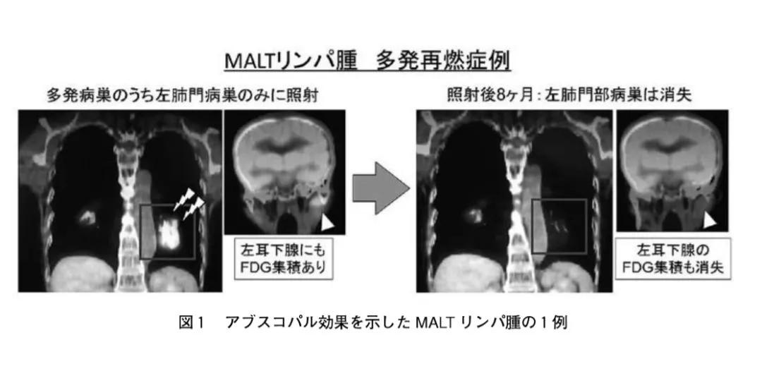 放疗仅是局部治疗?与免疫细胞疗法结合的它将成为抗癌最新利器！