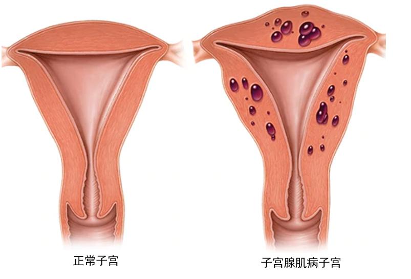 专家讲解子宫腺肌症,妇科医生子宫肌瘤讲解