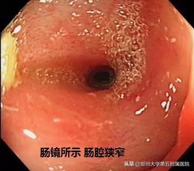 十来年肠绞痛的表现和处理方法,十年腹痛