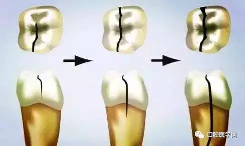 没有牙洞但是牙很疼,无坏牙但是还是牙痛