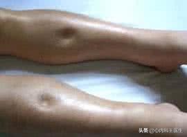 冠心病腿肿利尿药有用吗,冠心病腿肿就是心衰吗