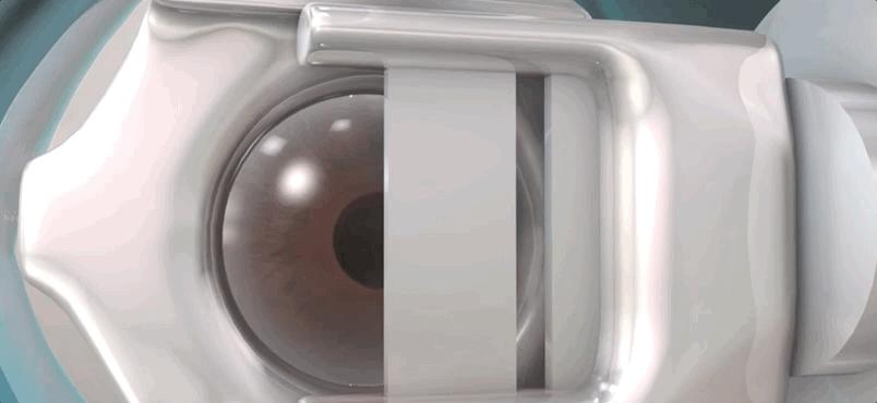 激光治疗近视什么原理,激光矫正是什么原理