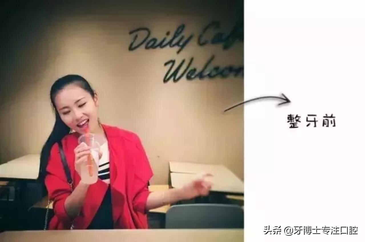 明星牙齿矫正前后对比,明星牙齿矫正都用的什么矫正方式