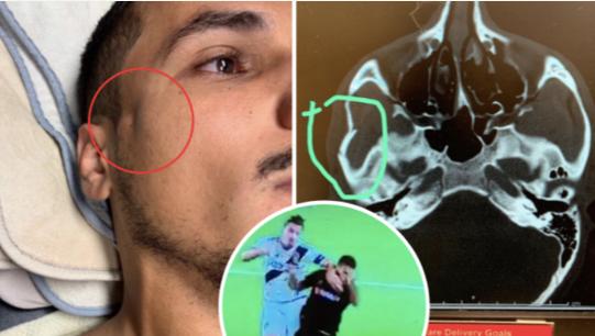 伊布十大暴力犯规集锦,伊布报复性手扇对手头部染红离场