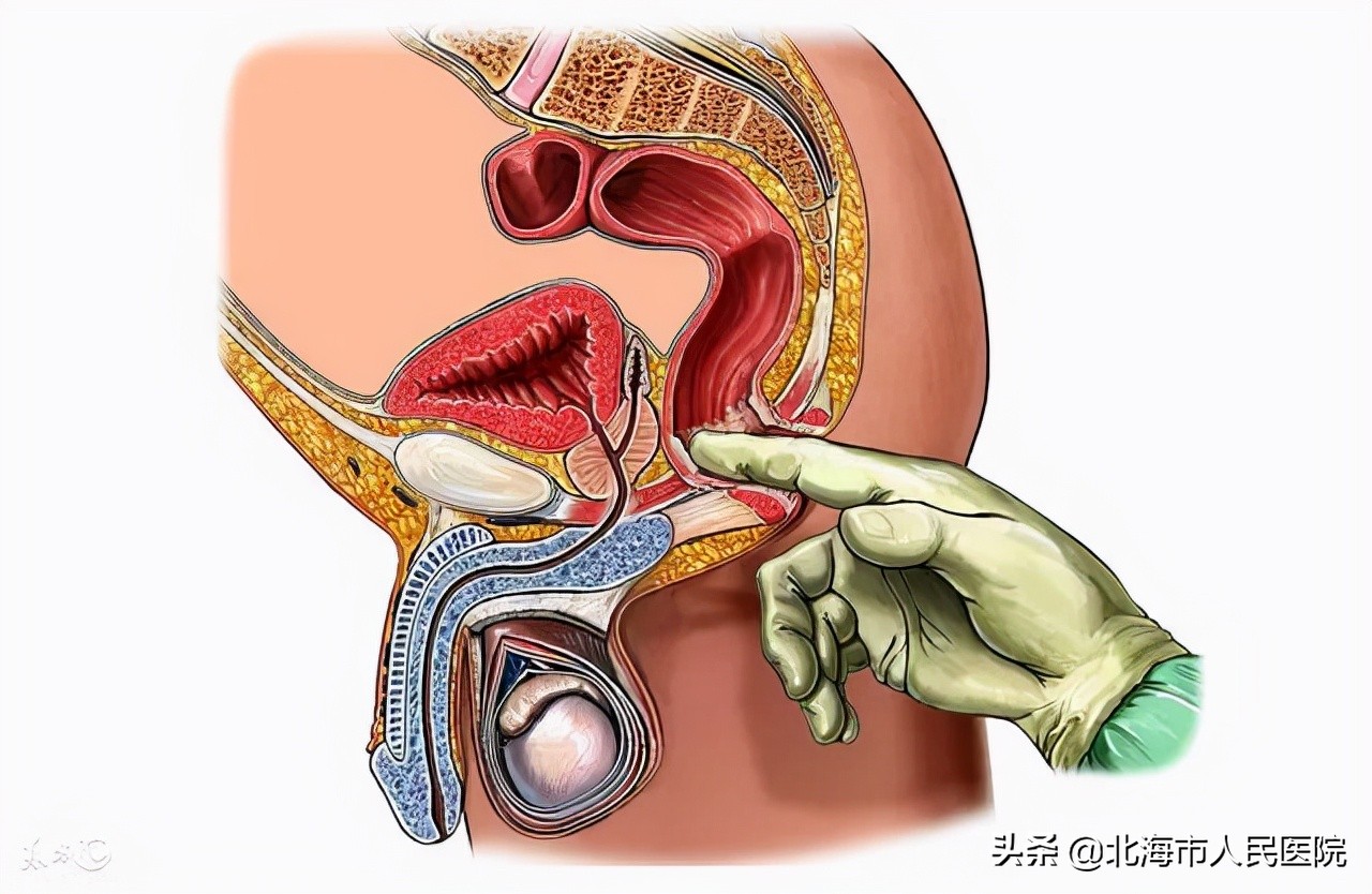 61岁医生患前列腺肿瘤去世,70岁早期前列腺癌手术