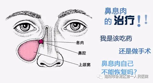 「卧龙区第一人民医院耳鼻喉科」“医生，我得鼻息肉了怎么办？”
