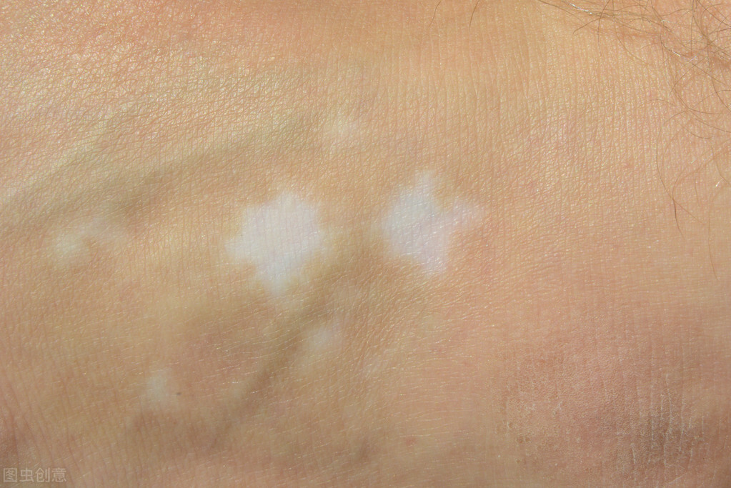 肚子上有白癜风怎么办,小朋友肚子白癜风