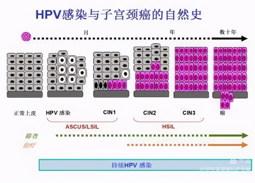 关于高危型hpv感染的视频,hpv恐慌