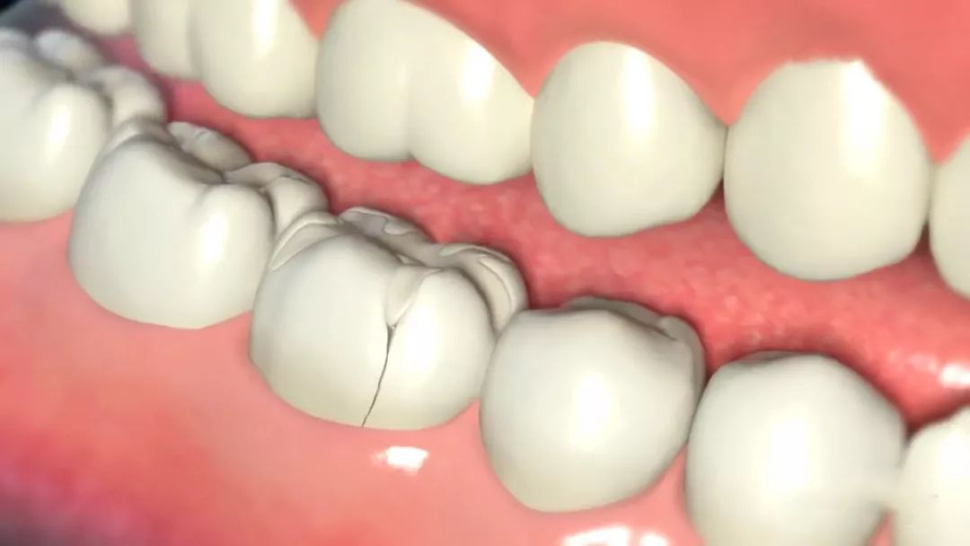 根管治疗全冠修复多少钱,根管治疗以后要做全冠吗