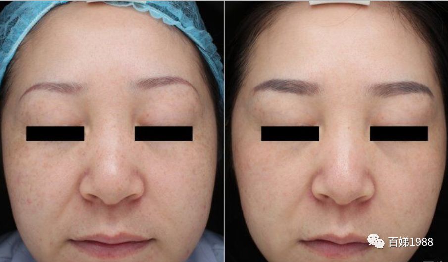 *褐斑黄**，你真正了解多少？碧芮斯带你真正了解“它”