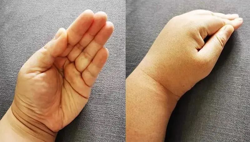 吸痰时使用吸痰管的正确手法,成人排痰的正确方法