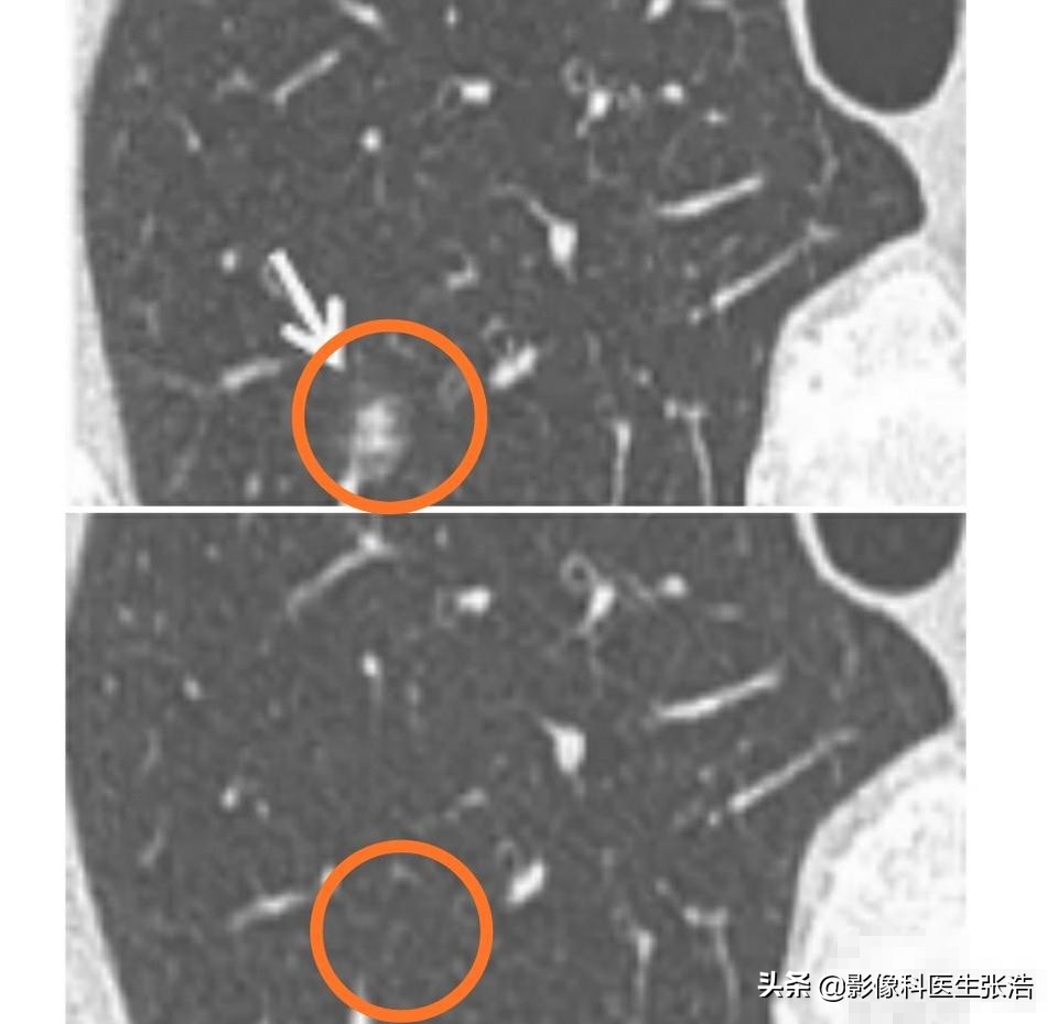 肺磨玻璃结节最终还是要手术吗,0.6-0.65cm磨玻璃结节需要手术吗
