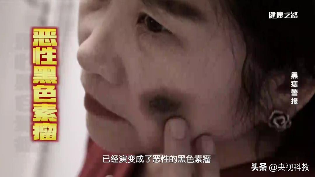 黑痣很容易恶变吗,身上黑痣出现什么状况有癌变发生