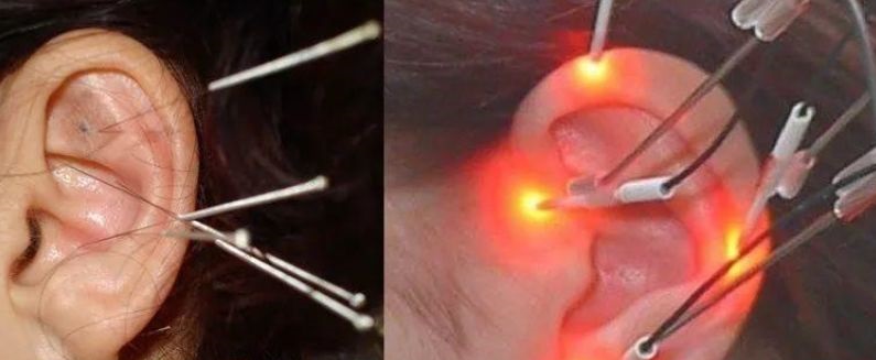 针灸的激光有什么用,医用激光针灸