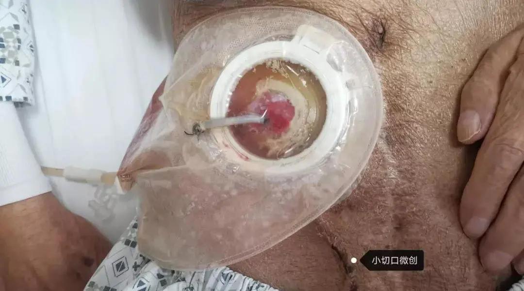 “大爷，你的肠子怎么老往外掉？”