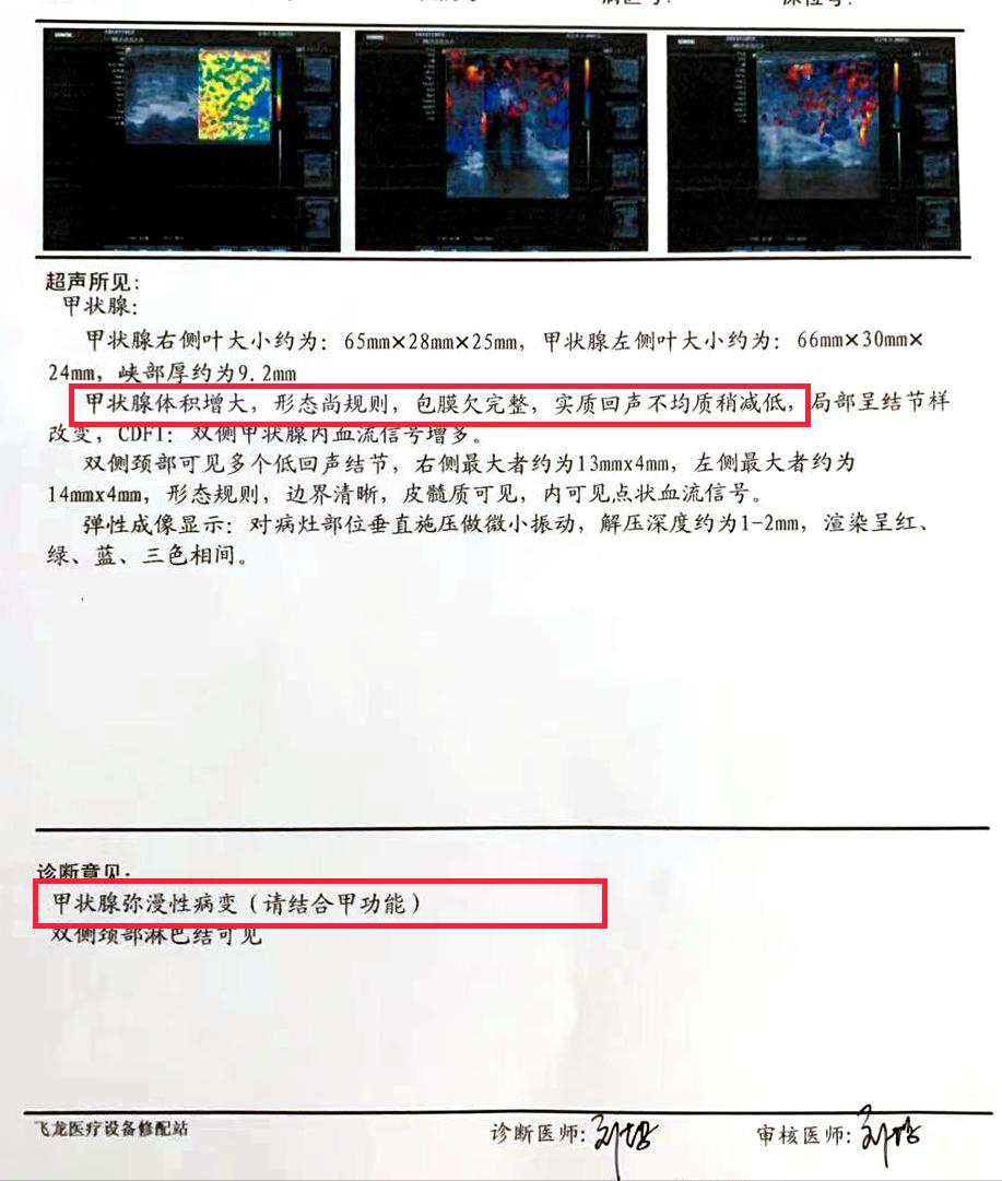 甲亢致人死亡,甲亢实际案例