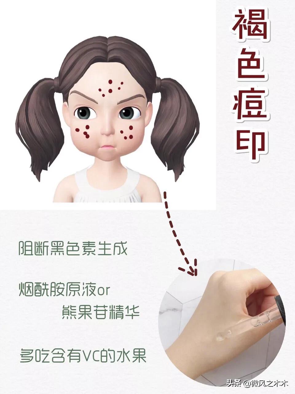 痘印痘坑消除要做多少次医美,去痘印痘坑痘疤的医美方法