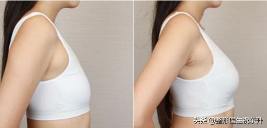 自体脂肪隆胸术后注意什么,自体脂肪隆胸术后怎么护理