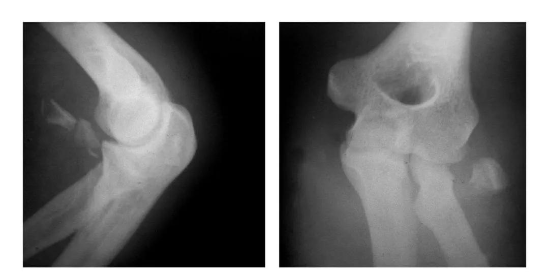青少年肘部损伤最常见的是,肘部桡神经损伤的临床表现