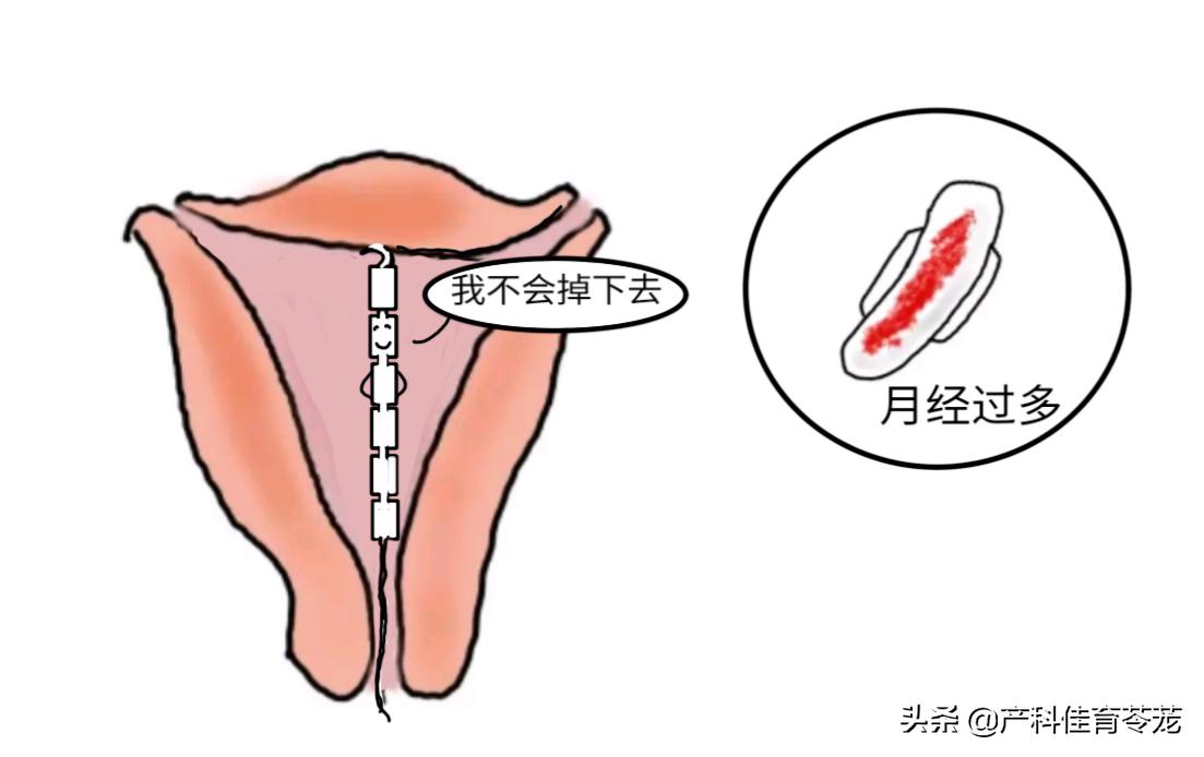 靠谱的避孕方法,疾病科普避孕方法之一