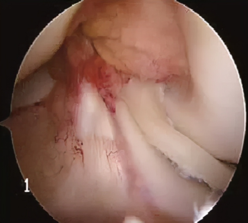 关节镜的适应症是什么,关节镜操作流程及注意事项