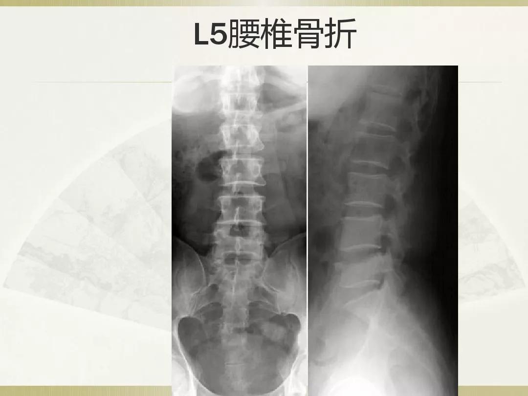 骨科x光片读片技巧,放射科骨科读片教程