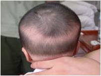 孩子枕秃是缺钙的表现吗 (宝宝枕秃补钙需要补多久)