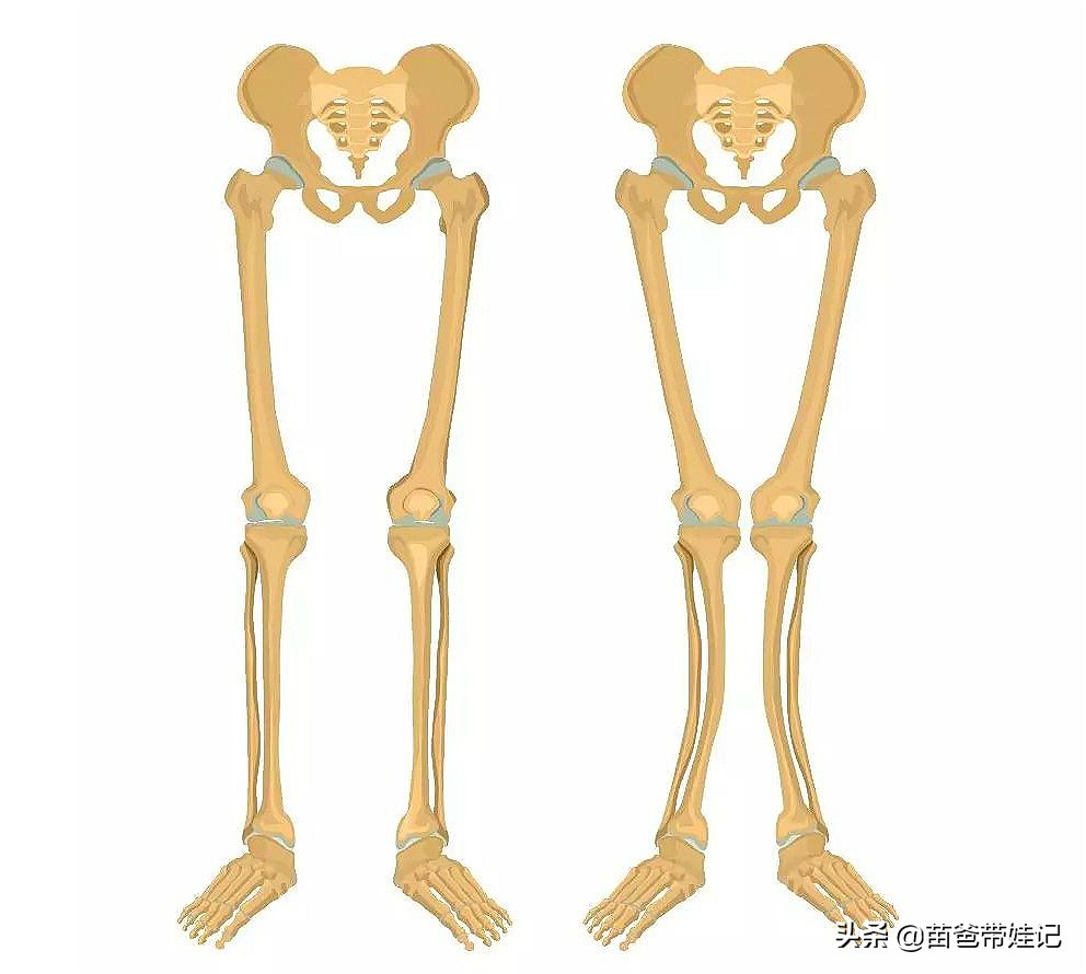 宝宝x型腿一定要治疗吗,宝宝x型腿例子