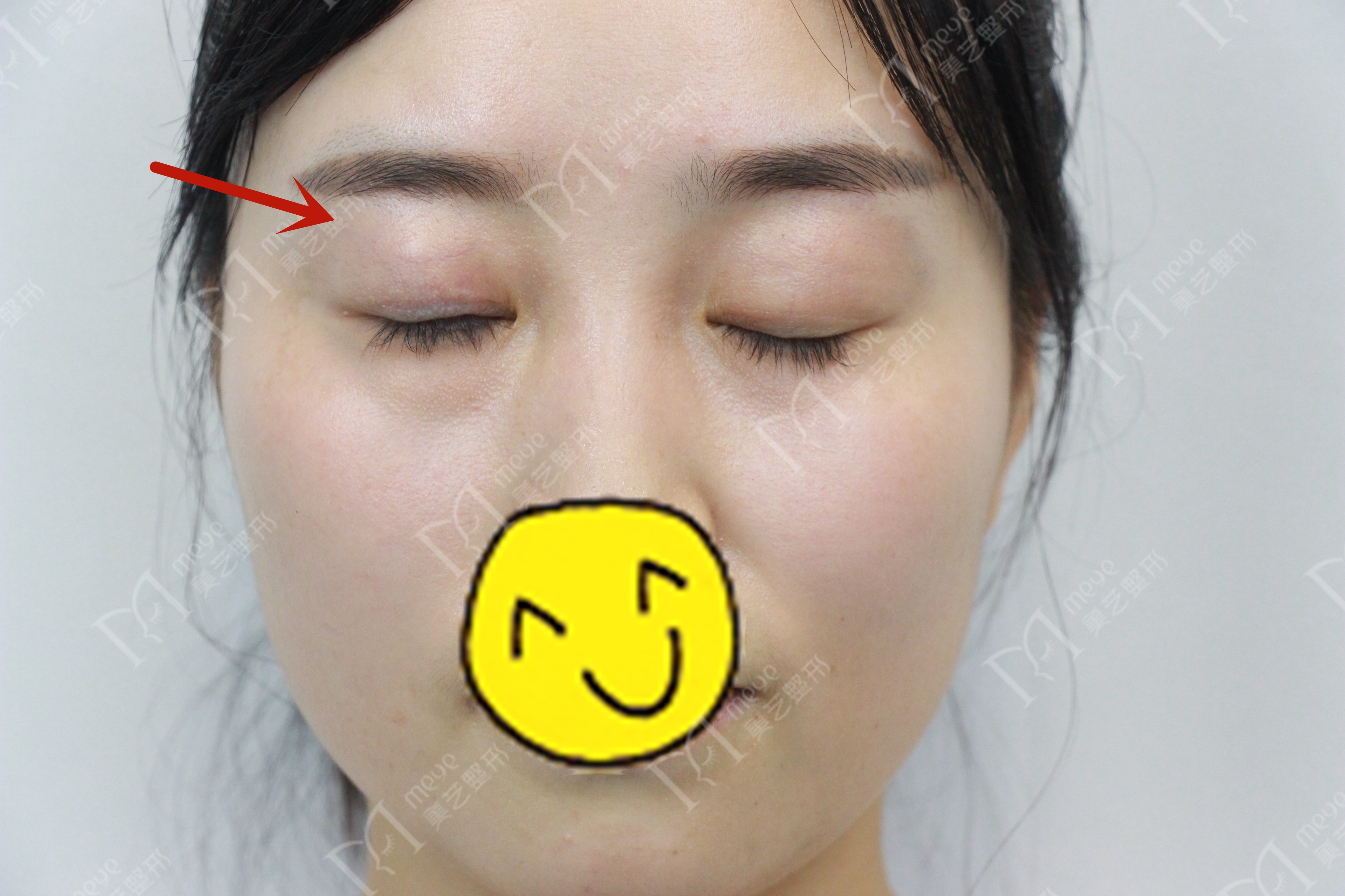 女子双眼皮术后大小眼,大小眼做了双眼皮感觉眼角不对称